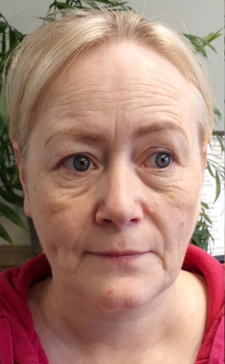 April Clare Brennan Beauty Collagen Lift ageing skin refresh radio frequency before
