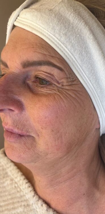 April Collagen Lift Jasper Rose Beauty glowing skin radio frequency before