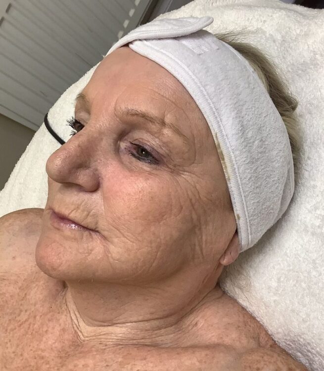 August Radiance Aesthetics ageing skin transformation SkinBase Collagen Lift results before