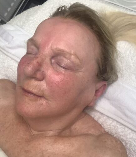 August Radiance Aesthetics ageing skin transformation SkinBase Collagen Lift results after