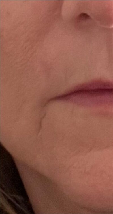 August The Beauty Room Birmingham Collagen Lift radio frequency jowls transformation after
