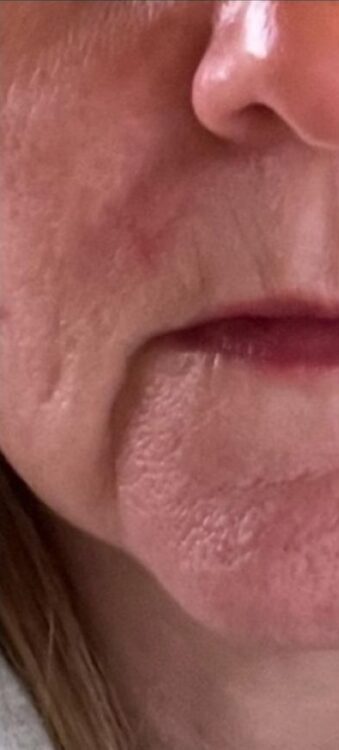 August The Beauty Room Birmingham Collagen Lift radio frequency jowls transformation before