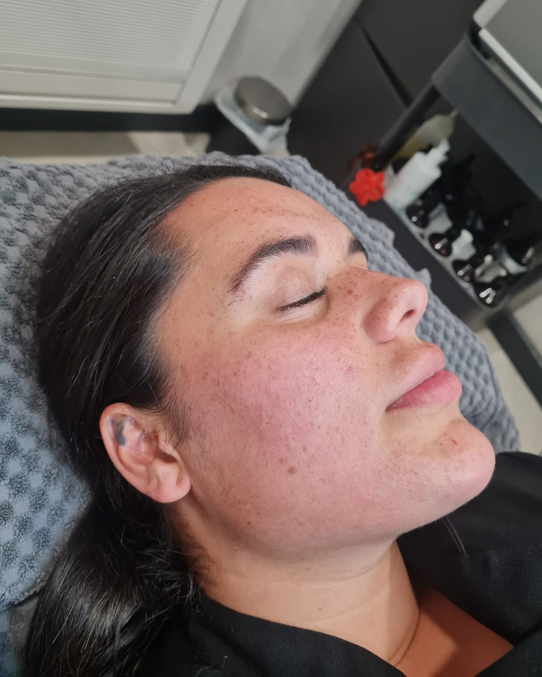 August The Spa at Hub 26 Microdermabrasion facial acne after