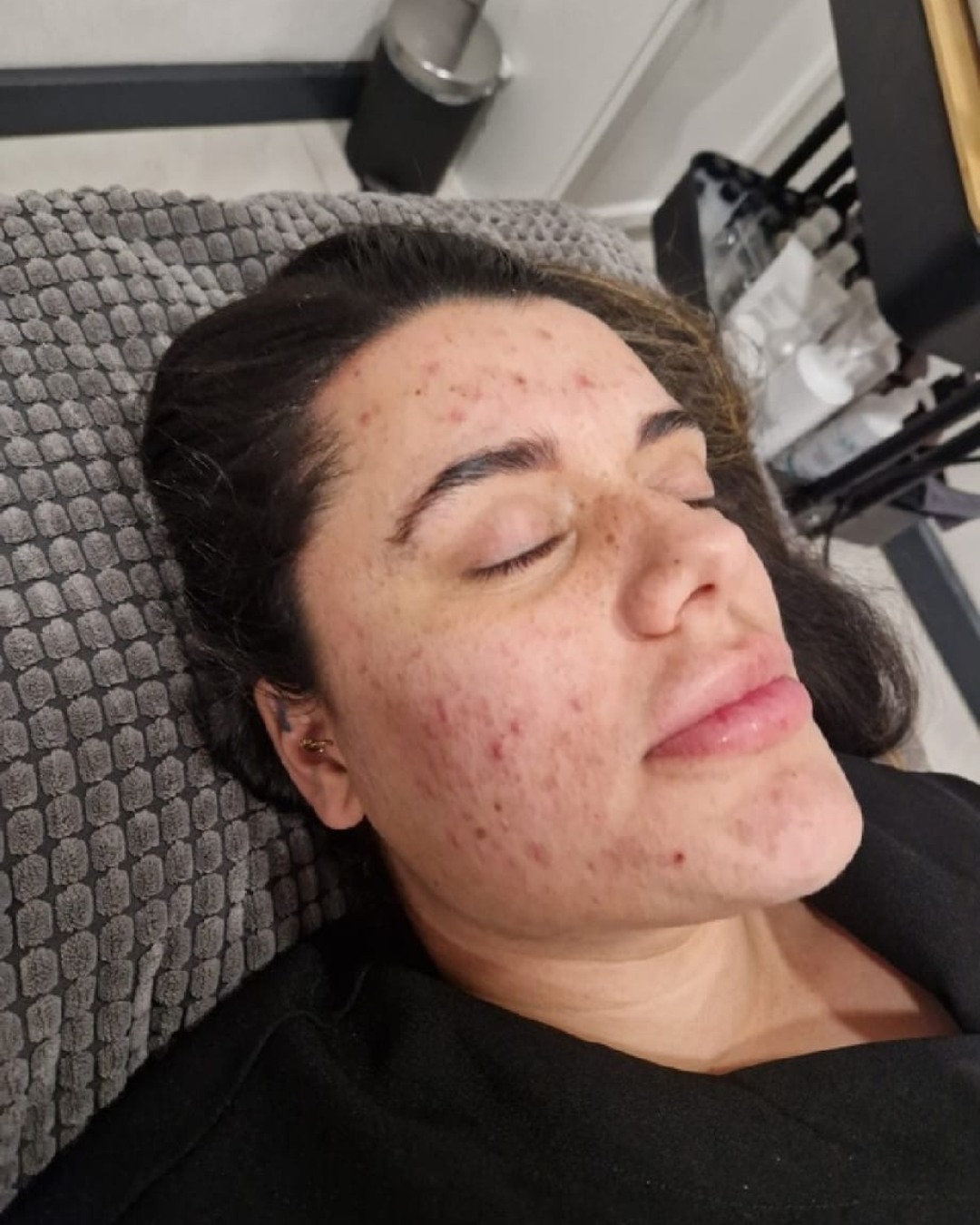 August The Spa at Hub 26 Microdermabrasion facial acne before