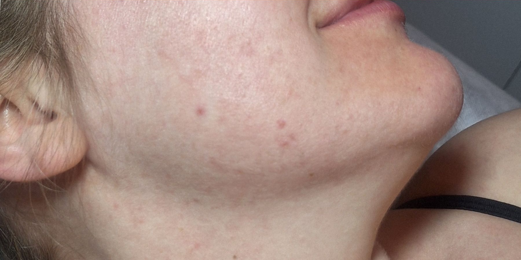 February Beautique Microdermabrasion after acne lower face