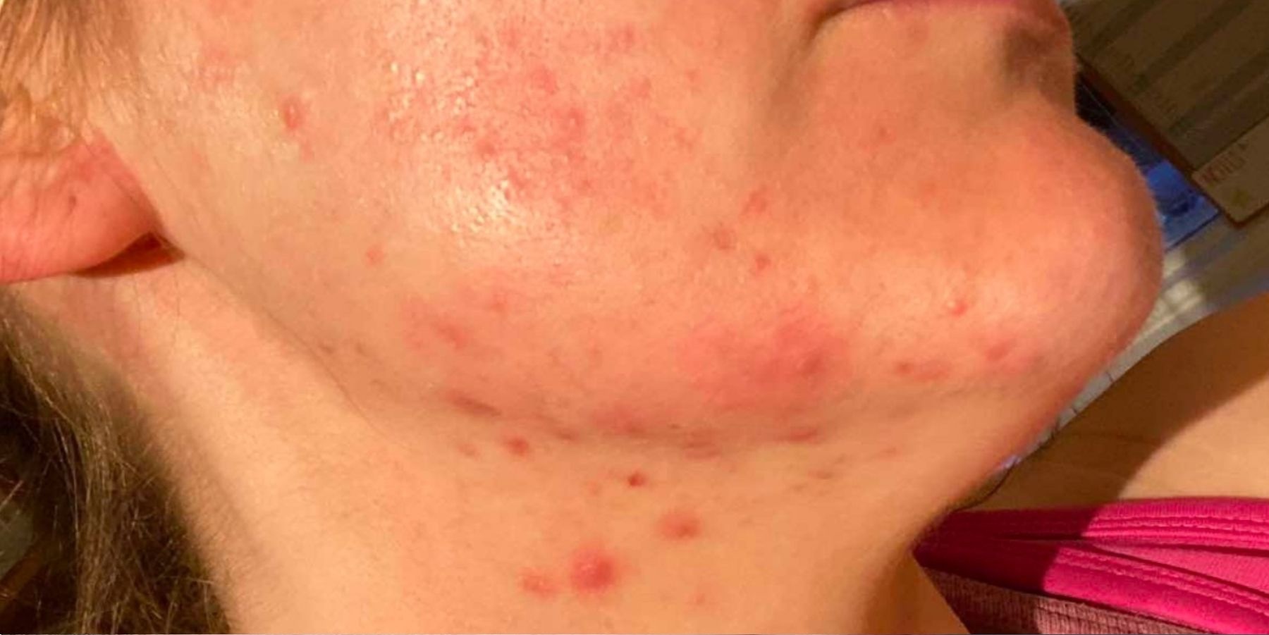 February Beautique Microdermabrasion before acne lower face