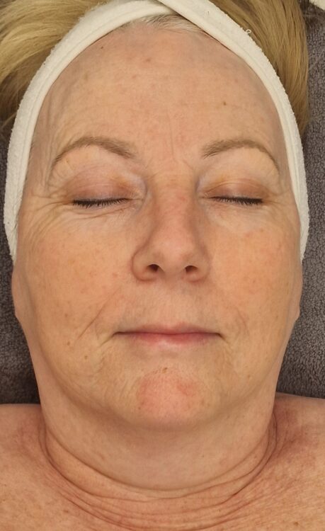 February Cassini Beauty Collagen Lift ageing skin radio frequency facial after