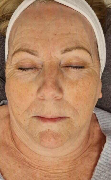 February Cassini Beauty Collagen Lift ageing skin radio frequency facial before
