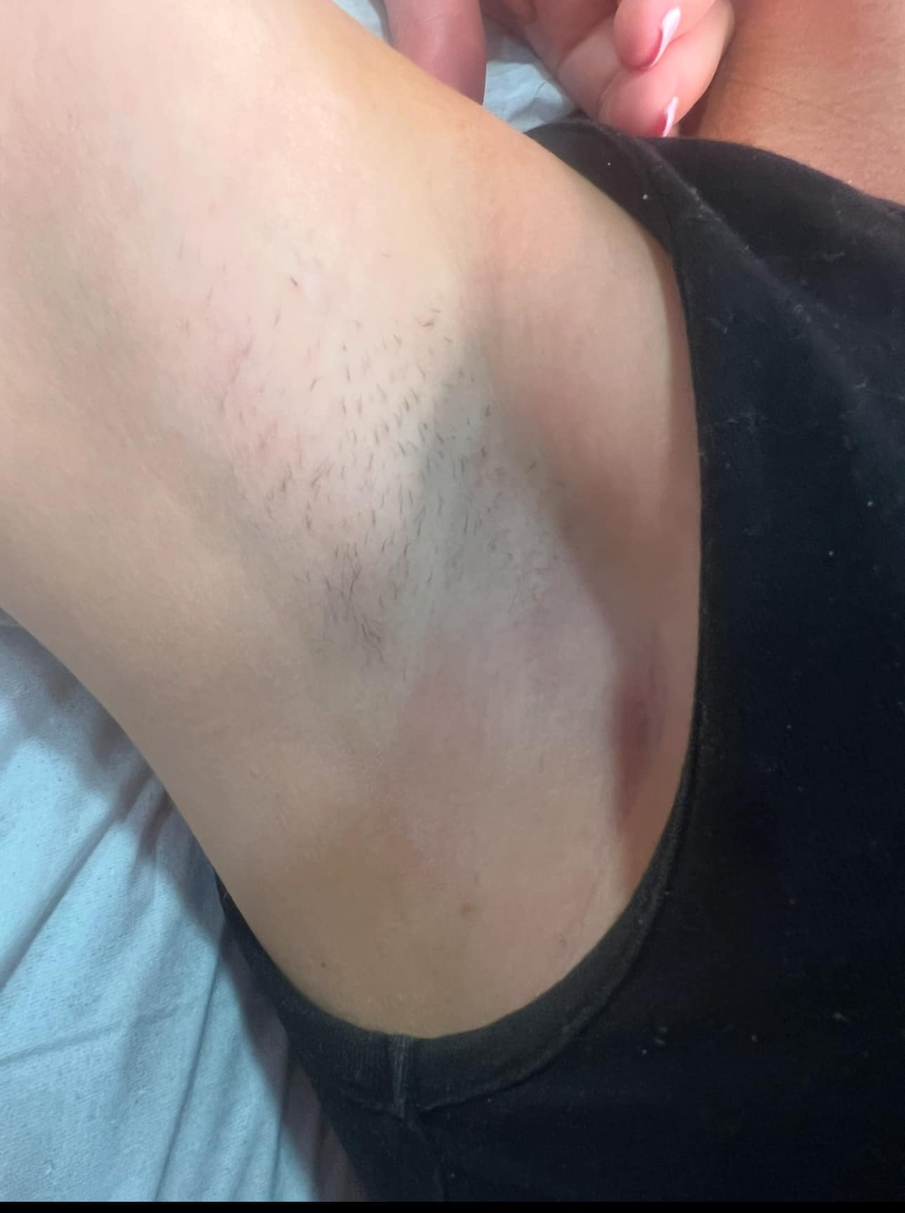 February Hayami Cosmetics IPL unwanted hair Underarm before