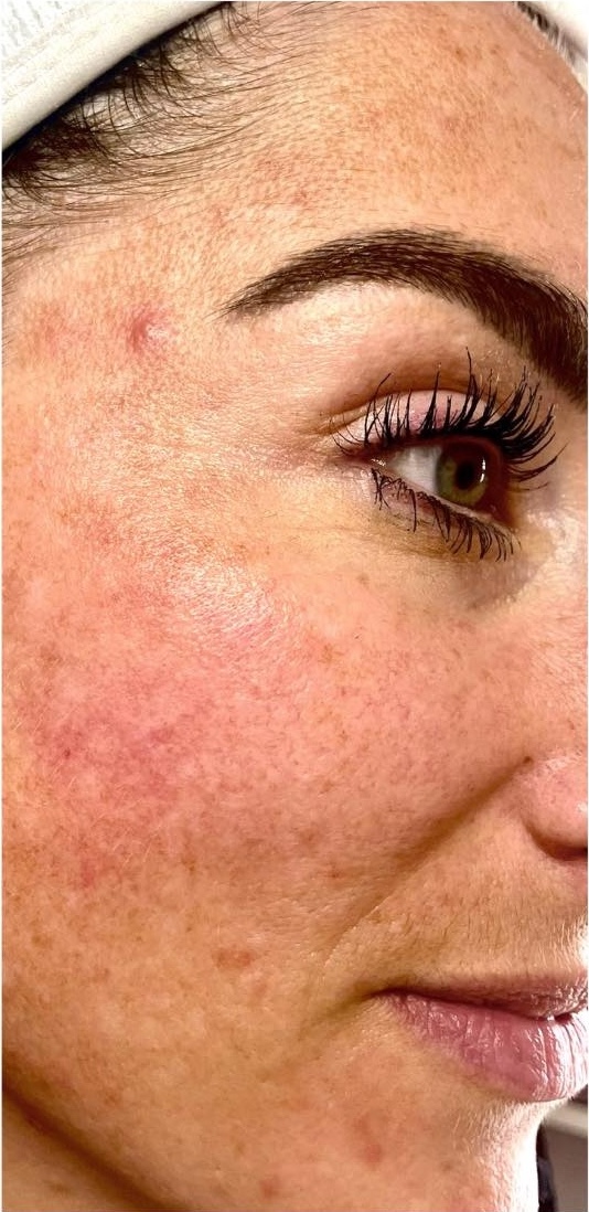 February Intense pulsed light Photorejuvenation Bijou Beauty Room face before
