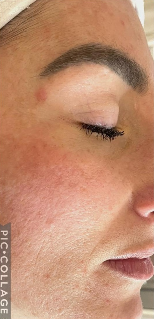 February Intense pulsed light Photorejuvenation Bijou Beauty Room face after