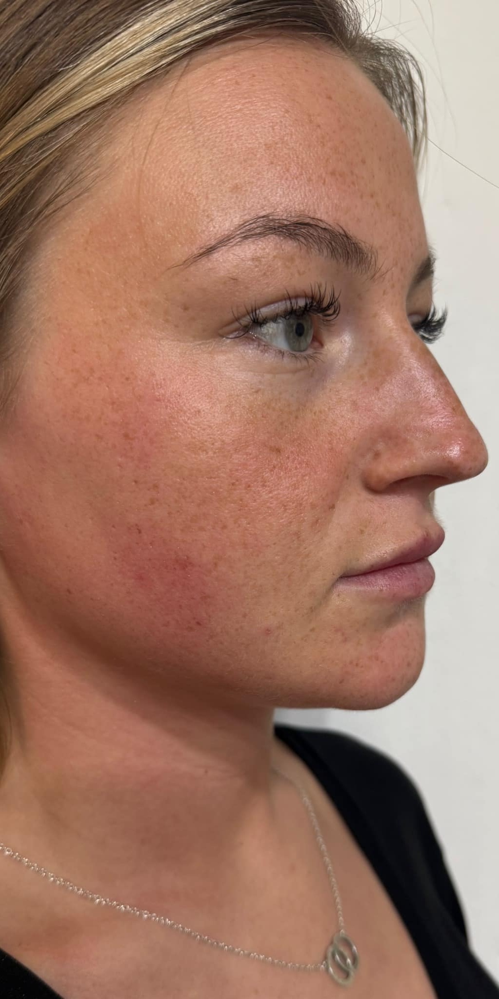 February Katherine Monique Beauty Microdermabrasion acne face after