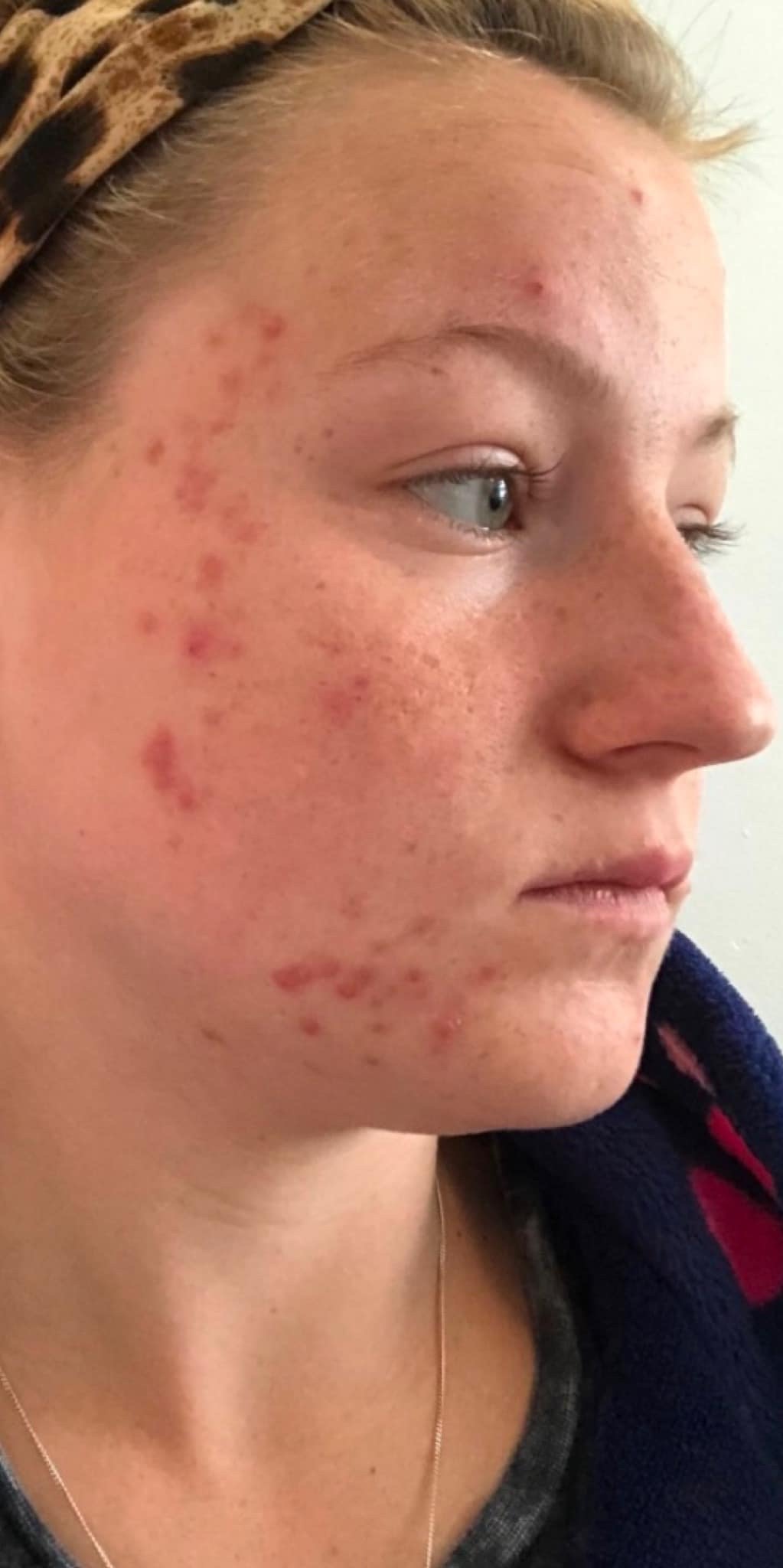 February Katherine Monique Beauty Microdermabrasion acne face before