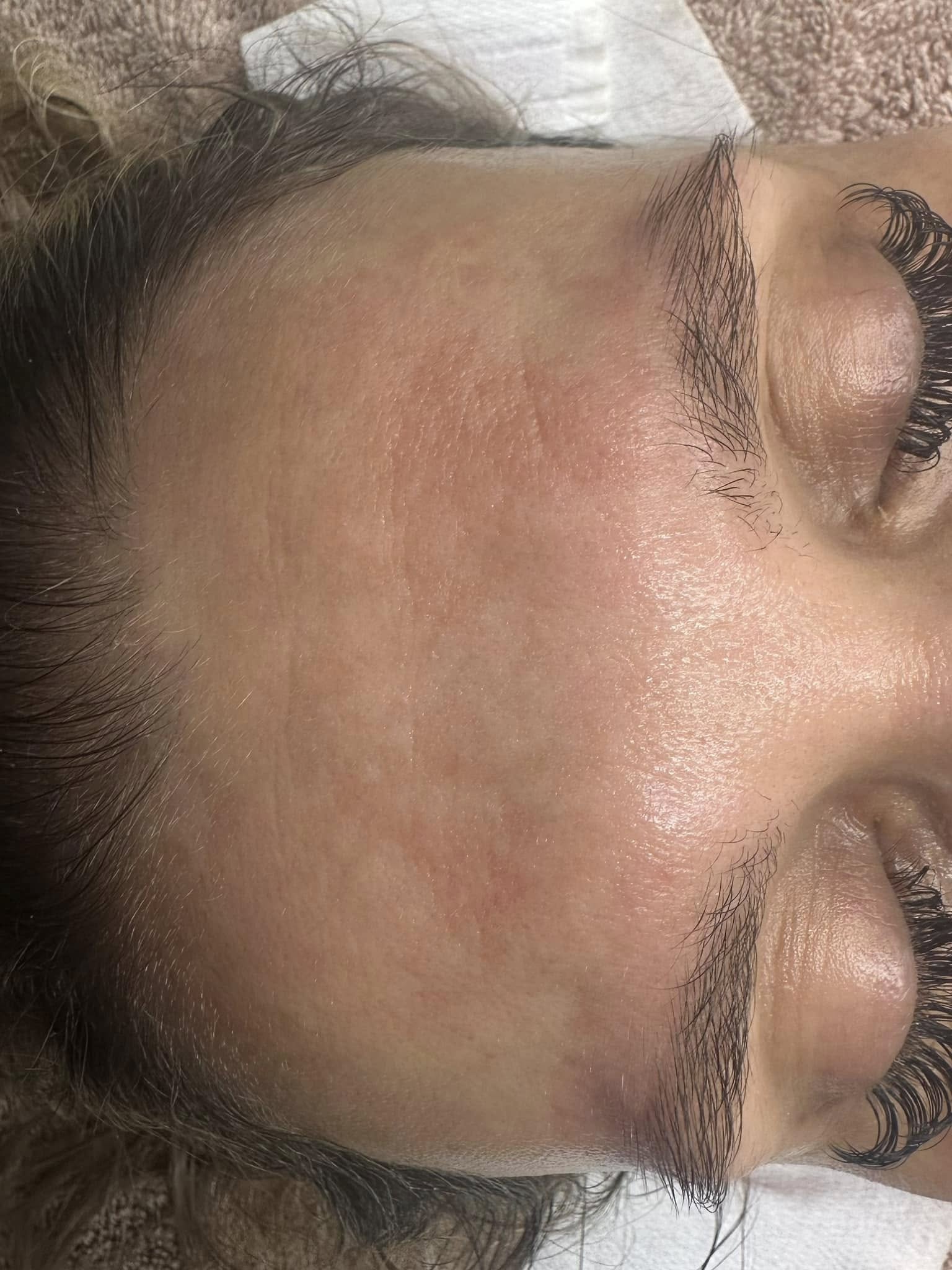 February Primrose Beauty and Aesthetics Microdermabrasion pigmentation forehead after