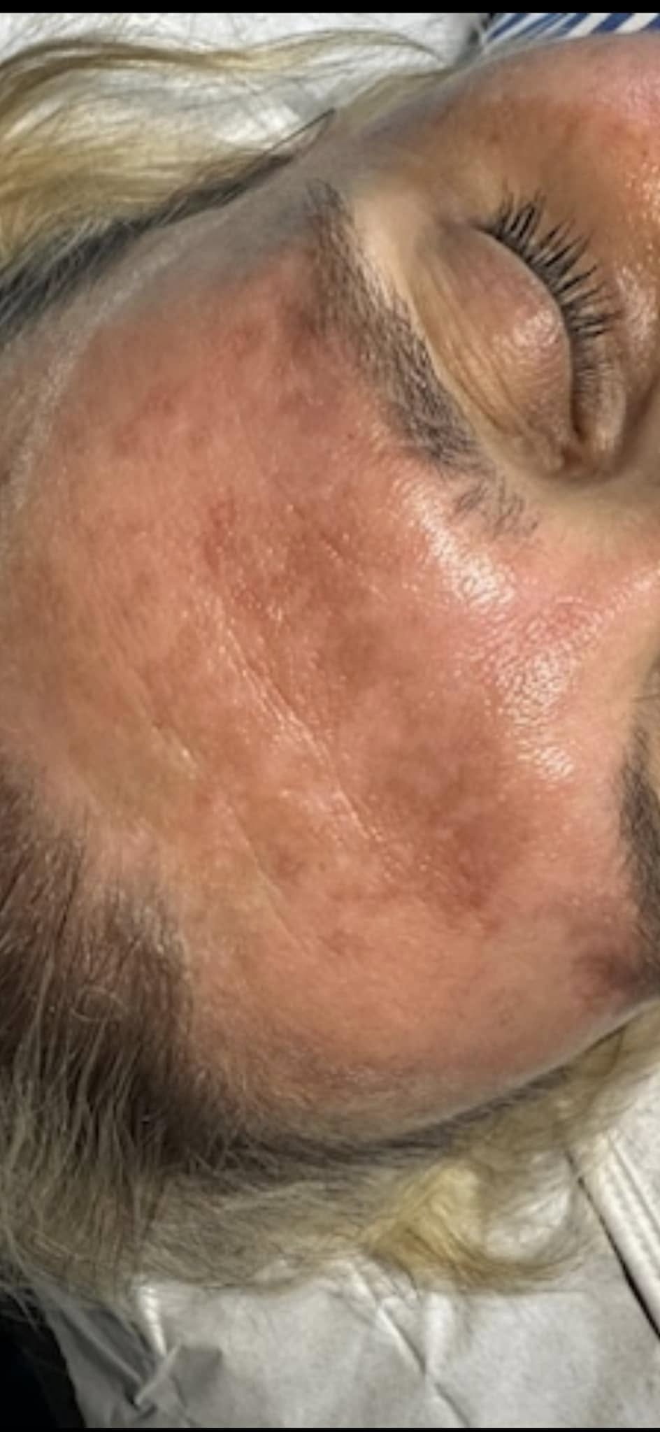 February Primrose Beauty and Aesthetics Microdermabrasion pigmentation forehead before