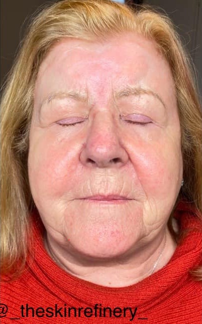 February The Skin Refinery intense pulsed light photorejuvenation rosacea face after