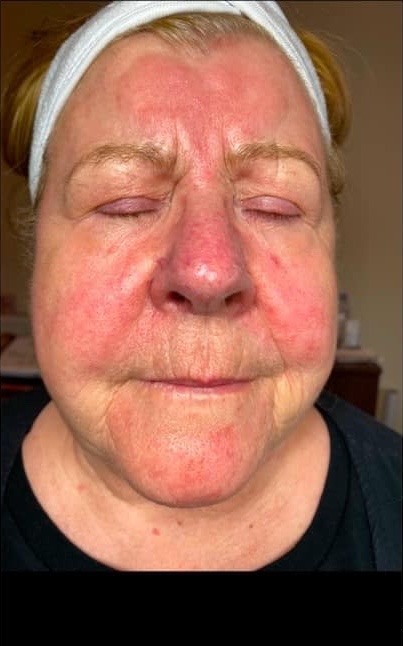 February The Skin Refinery intense pulsed light photorejuvenation rosacea face before