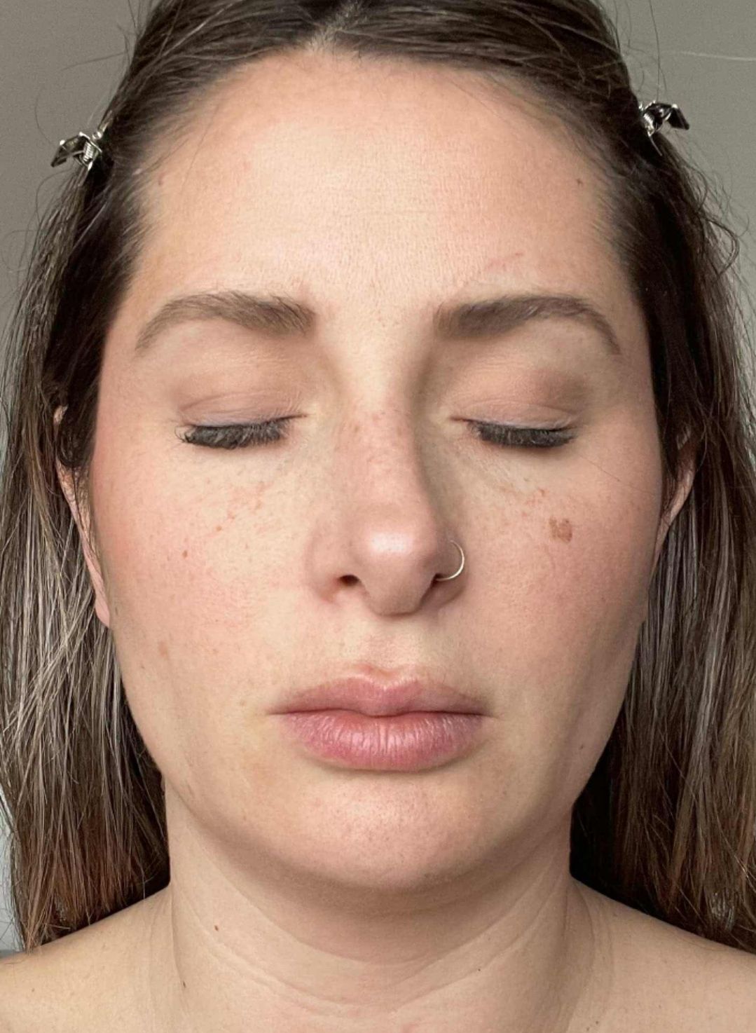 January Blissful Beauty by Clare intense pulsed light photorejuvenation pigmentation before