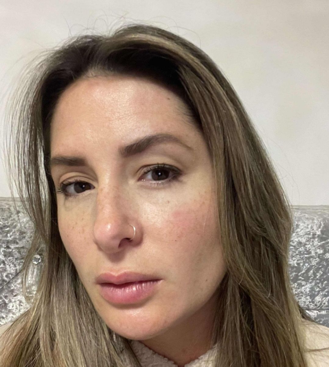 January Blissful Beauty by Clare intense pulsed light photorejuvenation pigmentation after
