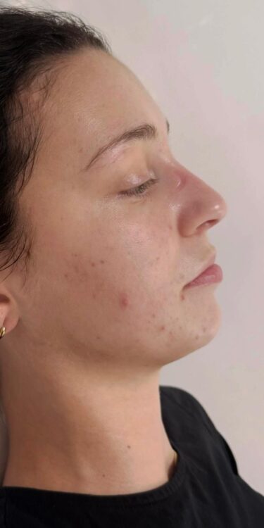 January Katherine Monique Beauty acne hydro clarifying face after