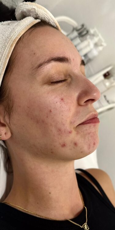 January Katherine Monique Beauty acne hydro clarifying face before
