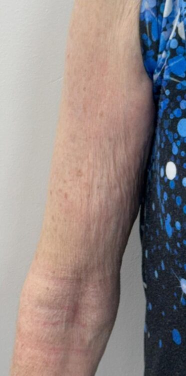 January Revive Health and Beauty SkinBase Collagen Lift Arms results after