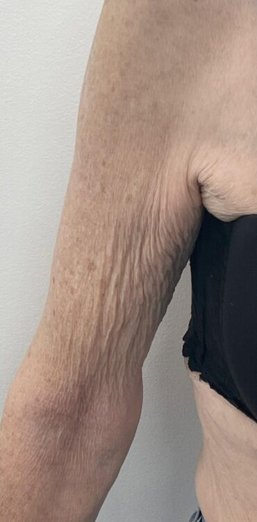January Revive Health and Beauty SkinBase Collagen Lift Arms results before