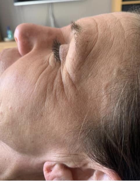 January Theblissfulbeautycompany ageing skin collagen lift radio frequency microdermabrasion results before