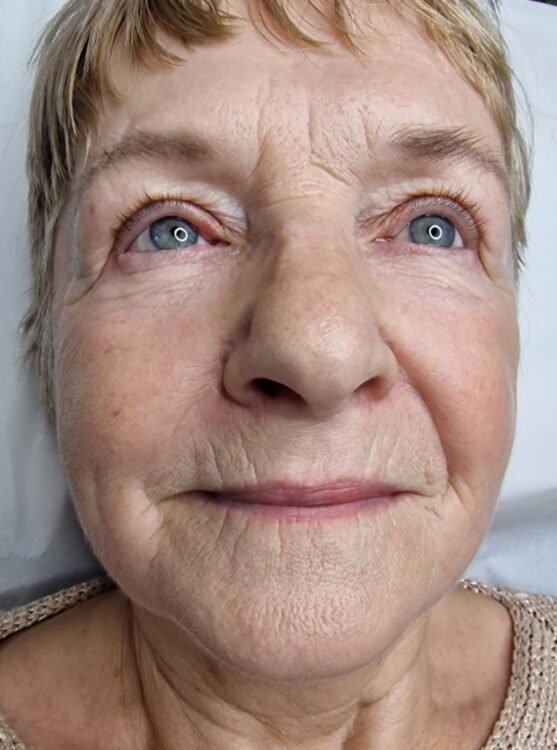 July A Beauty Lounge Portsmouth ageing skin rejuvenation skinbase Collagen Lift results before