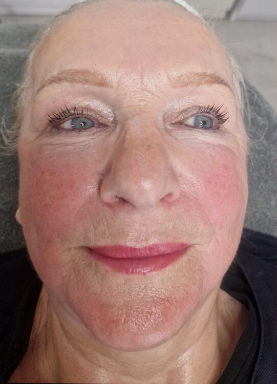 July A Beauty Lounge Portsmouth ageing skin rejuvenation skinbase Collagen Lift results after
