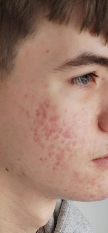 July Lotus Beauty Lounge Microdermabrasion Hydro acne facial male after
