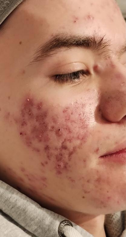 July Lotus Beauty Lounge Microdermabrasion Hydro acne facial male before