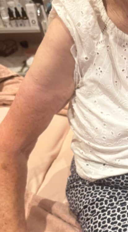 July Niki PT Beauty Collagen Lift arms transformation sagging skin tightening after