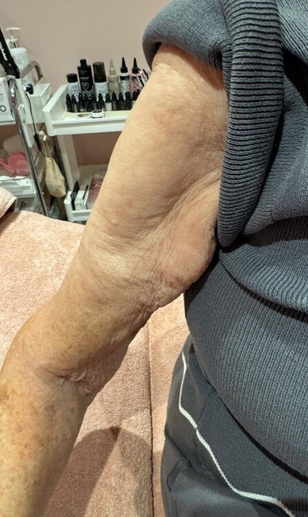 July Niki PT Beauty Collagen Lift arms transformation sagging skin tightening before