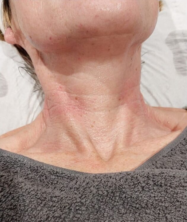 July Perfectly Pampered by Kerry Collagen Lift non surgical neck rejuvenation radio frequency results after