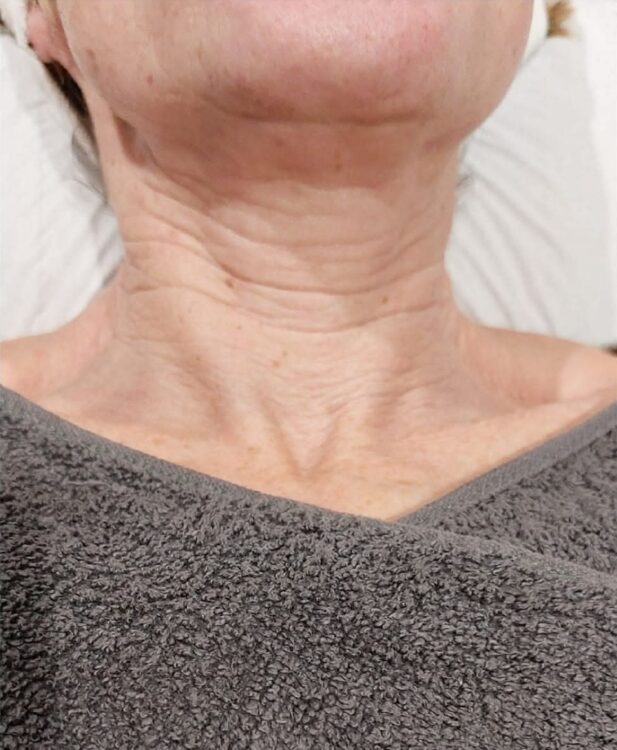 July Perfectly Pampered by Kerry Collagen Lift non surgical neck rejuvenation radio frequency results before