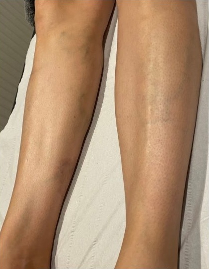 July Serenity Carluke Intense Pulsed Light unwanted hair legs after