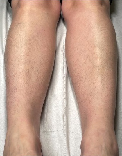 July Serenity Carluke Intense Pulsed Light unwanted hair legs before