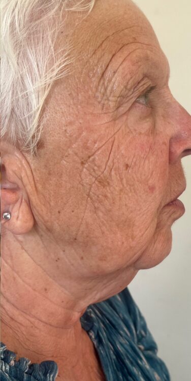 July The Beauty Room Nicola Hounsell Collagen Lift ageing skin sun damage rejuvenation skinbase radio frequency treatment after