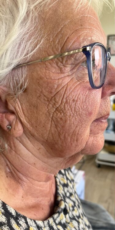 July The Beauty Room Nicola Hounsell Collagen Lift ageing skin sun damage rejuvenation skinbase radio frequency treatment before