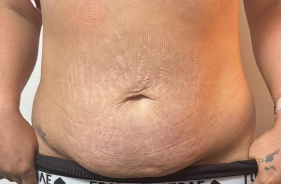 June Head to Toe Baillieston Collagen Lift tummy transformation loose skin stretch marks radio frequency rejuvenation after