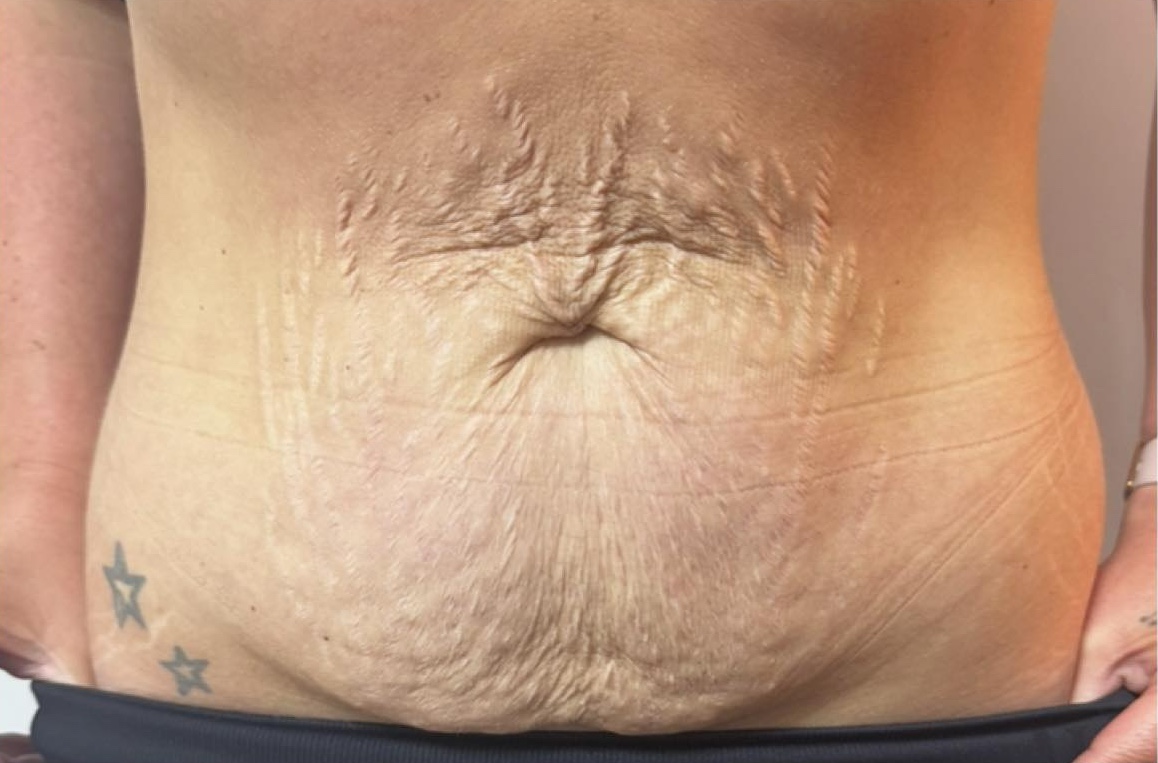 June Head to Toe Baillieston Collagen Lift tummy transformation loose skin stretch marks radio frequency rejuvenation before