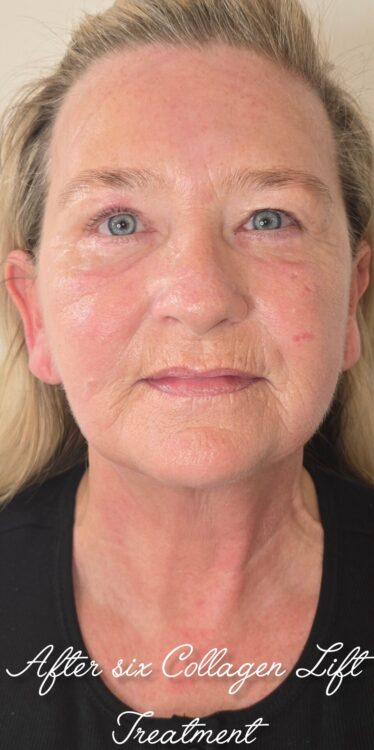June Ice Aesthetics Collagen Lift skin rejuvenation after