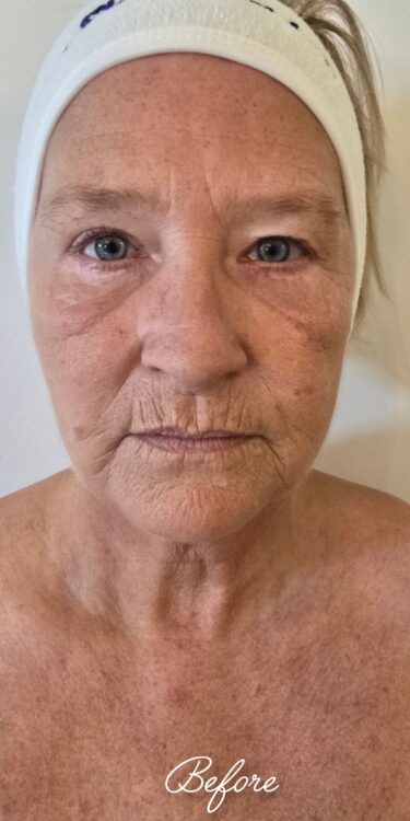 June Ice Aesthetics Collagen Lift skin rejuvenation before