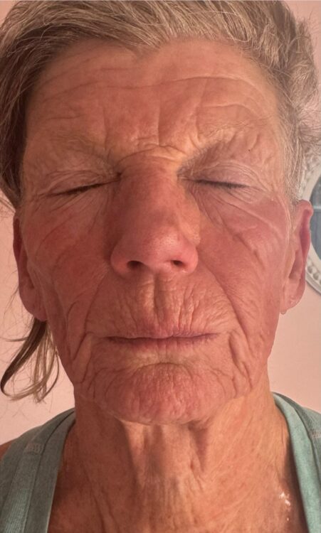 June Niki PT and Beauty Therapy Collagen Lift sun damage radio frequency ageing skin rejuvenation after