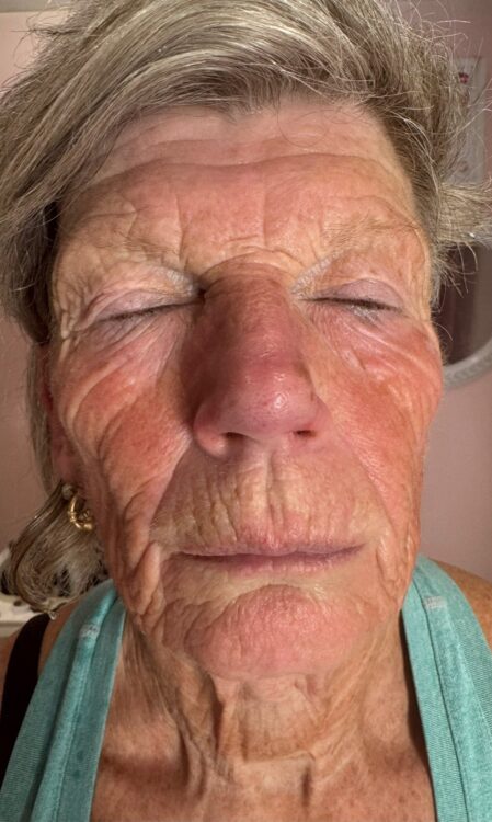 June Niki PT and Beauty Therapy Collagen Lift sun damage radio frequency ageing skin rejuvenation before