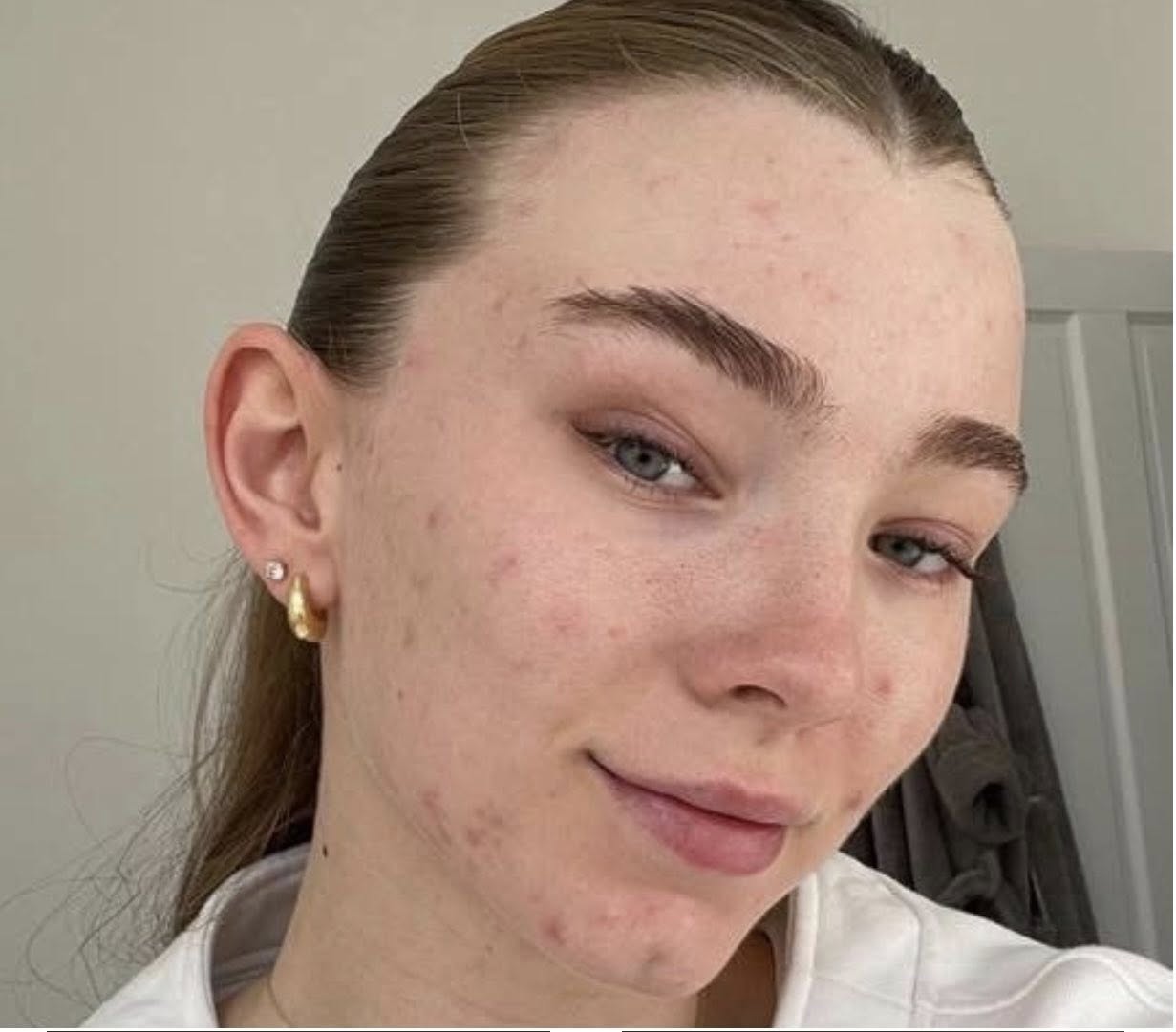 June Pampered by Elaine Hydro acne face before