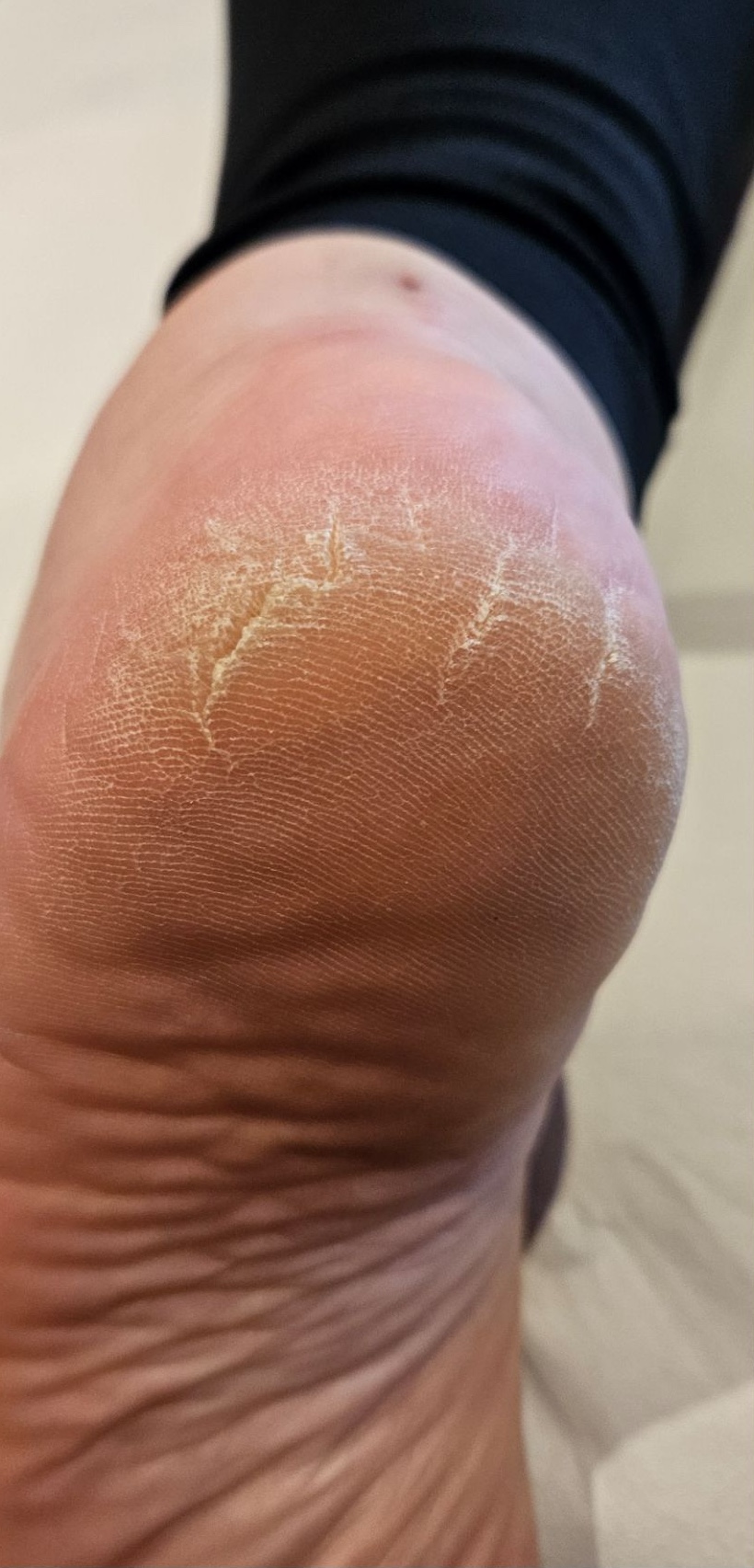 June The Beauty Room Microdermabrasion feet pedicure before