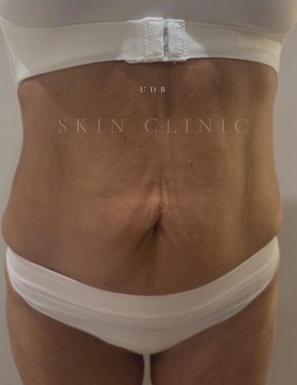 June UDB Skin Therapy collagen lift radio frequency loose sagging skin weight loss tightening after