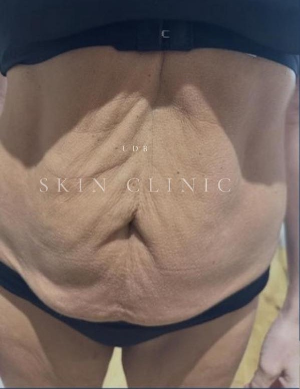 June UDB Skin Therapy collagen lift radio frequency loose sagging skin weight loss tightening before